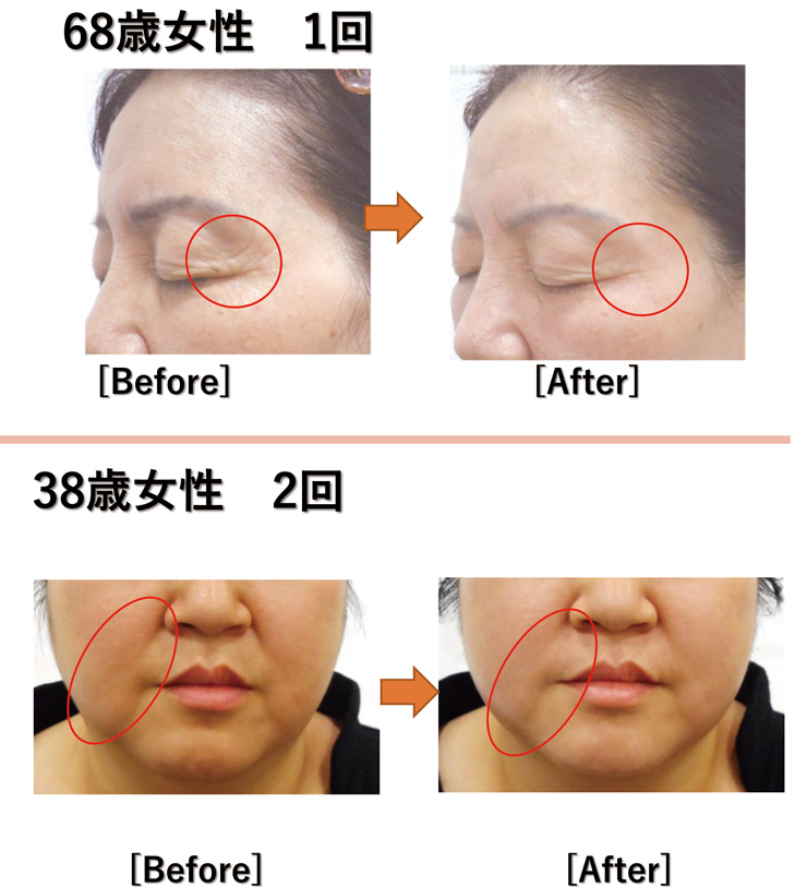 CelluliteZero2ビフォーアフター